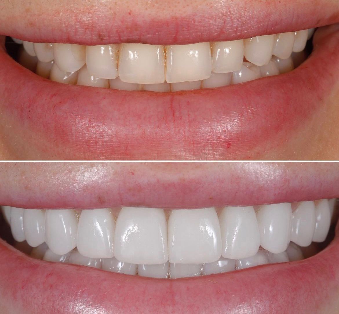Antes e depois — facetas estéticas