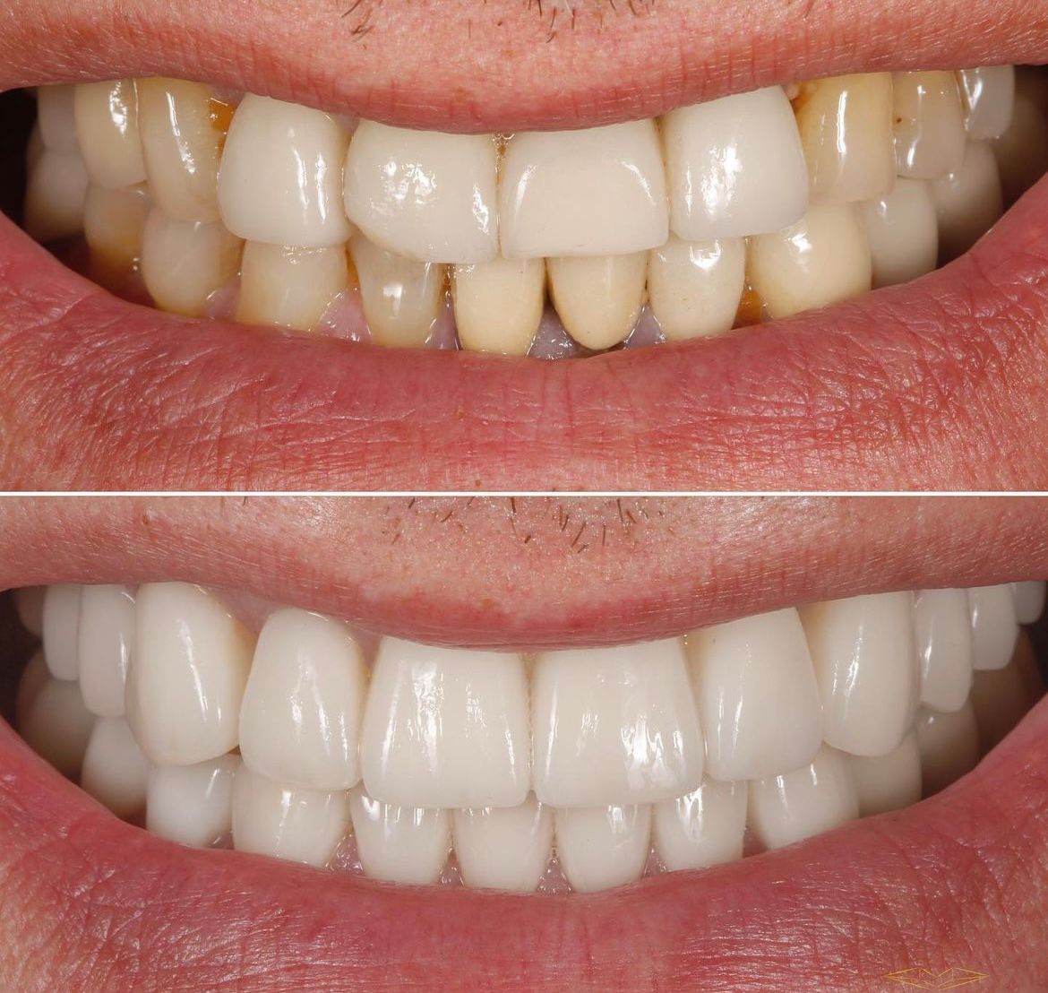 Antes e depois — reabilitação oral