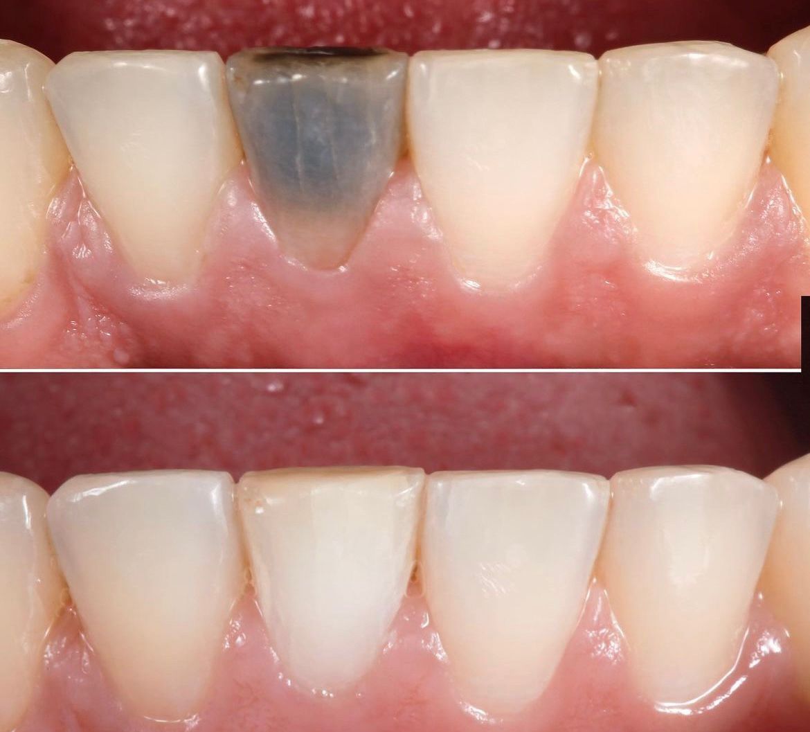 Antes e depois — clareamento dentário
